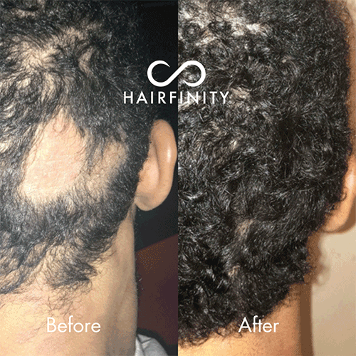 Hairfinity Infinite Edges Serum for Alopecia & Hair Loss