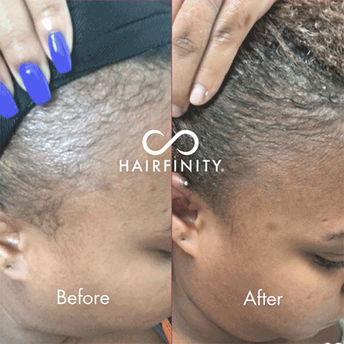 Hairfinity Infinite Edges Serum for Alopecia & Hair Loss