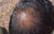 Hair Miniaturization: What it is and How to Stop it
