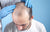 Scalp Infections That Can Cause Hair Loss