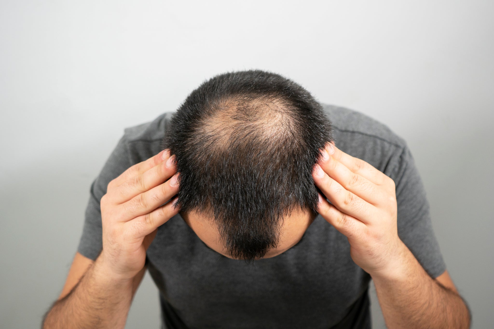 Various stages of baldness and how to treat it