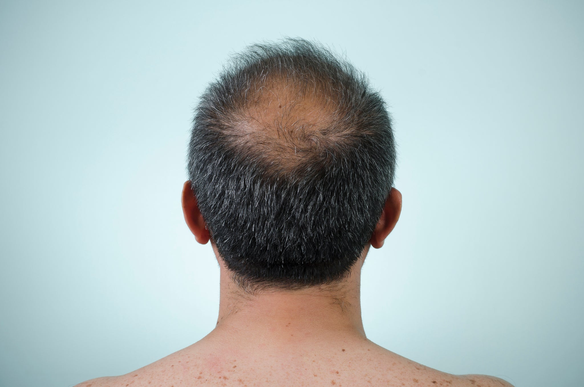 Common Topical Finasteride Side Effects